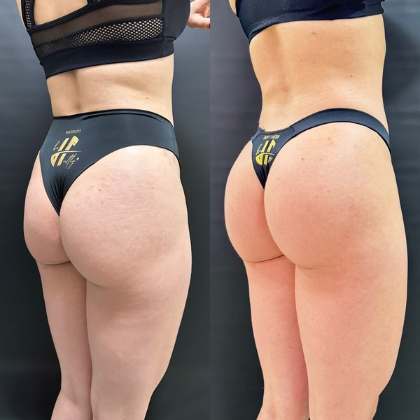 Antes e depois, paciente A, ângulo lateral
