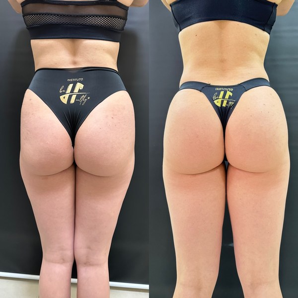 Antes e depois, paciente A, ângulo posterior