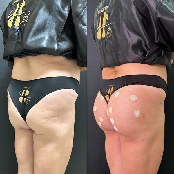 Antes e depois, paciente C, ângulo 1