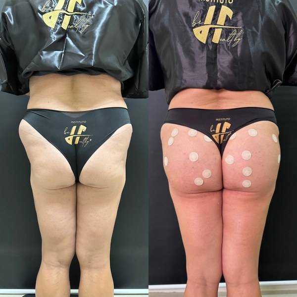 Antes e depois, paciente C, ângulo 2