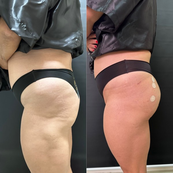 Antes e depois, paciente C, ângulo 3