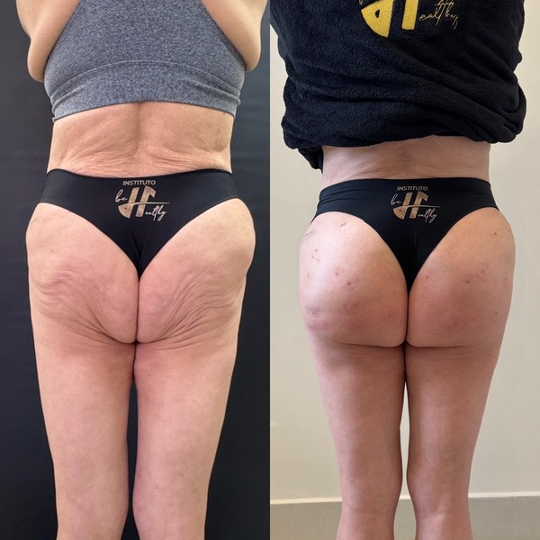 Antes e depois, paciente F, ângulo 1