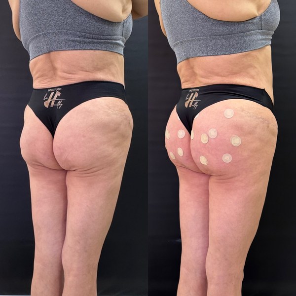 Antes e depois, paciente F, ângulo 2