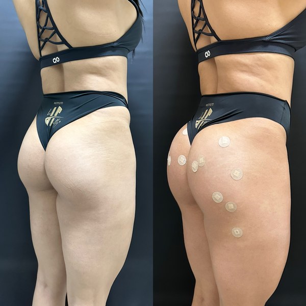 Antes e depois, paciente G, ângulo 1
