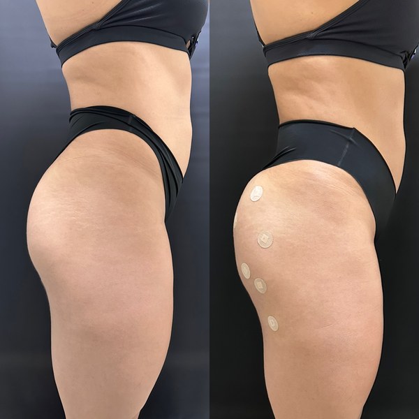 Antes e depois, paciente G, ângulo 2