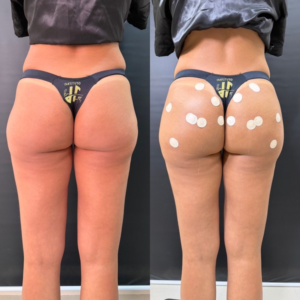 Antes e depois, paciente L, ângulo 1