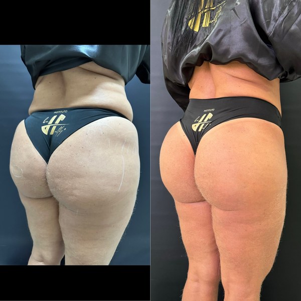 Antes e depois, paciente M, ângulo 1