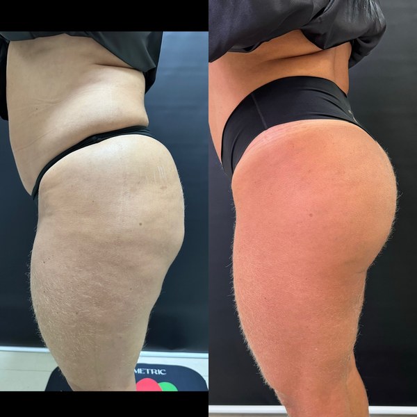 Antes e depois, paciente M, ângulo 2