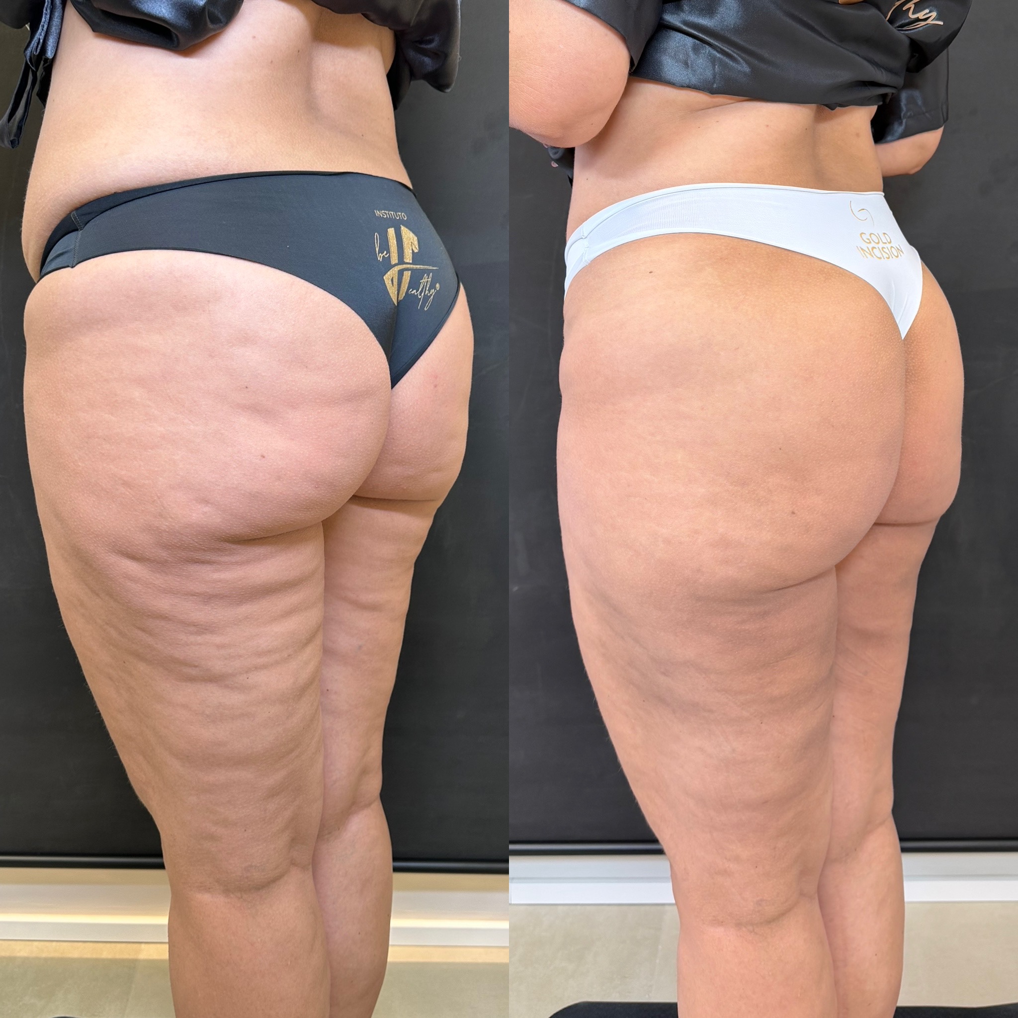 Resultado GoldIncision® no Instituto Be Healthy