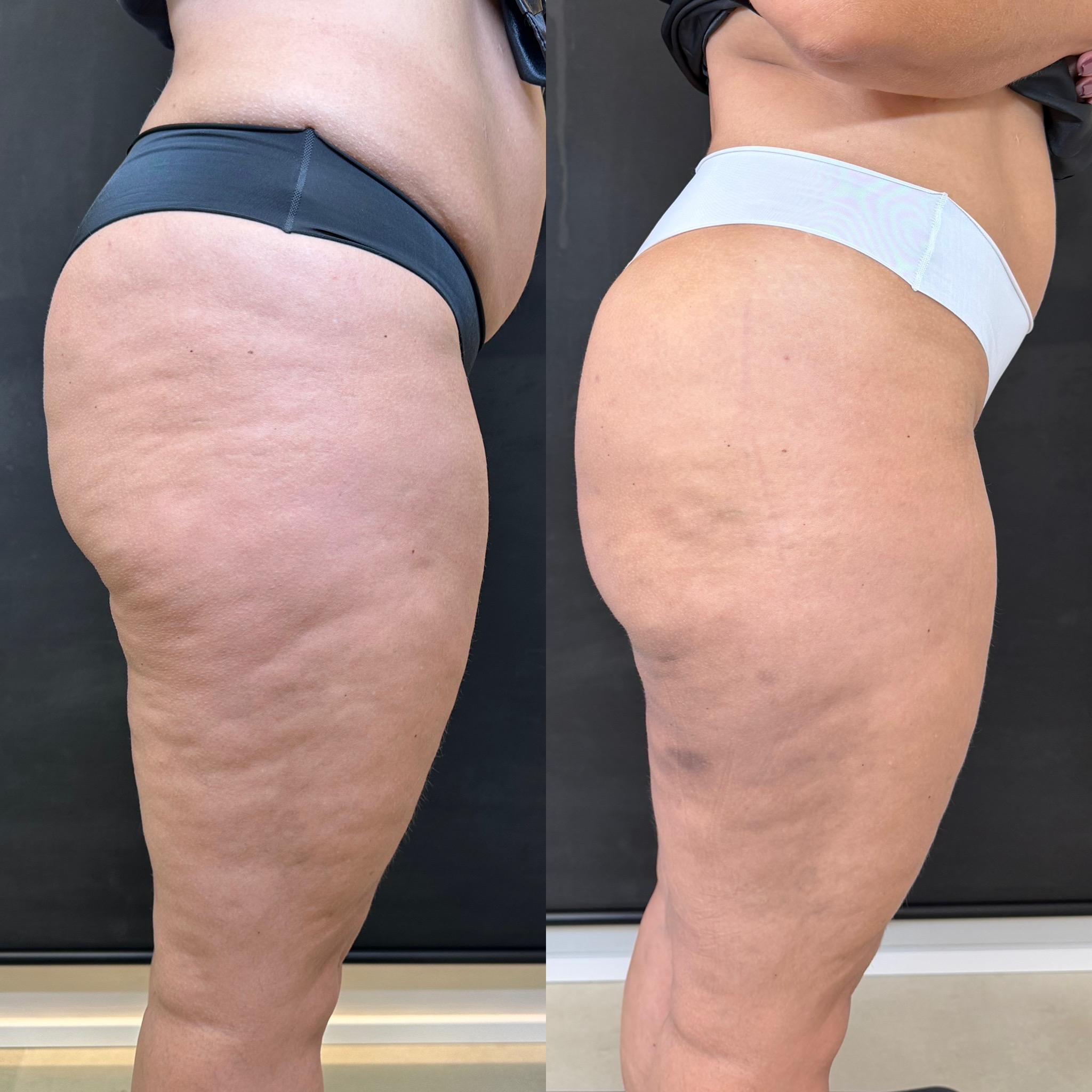 Antes e depois GoldIncision® — vista lateral