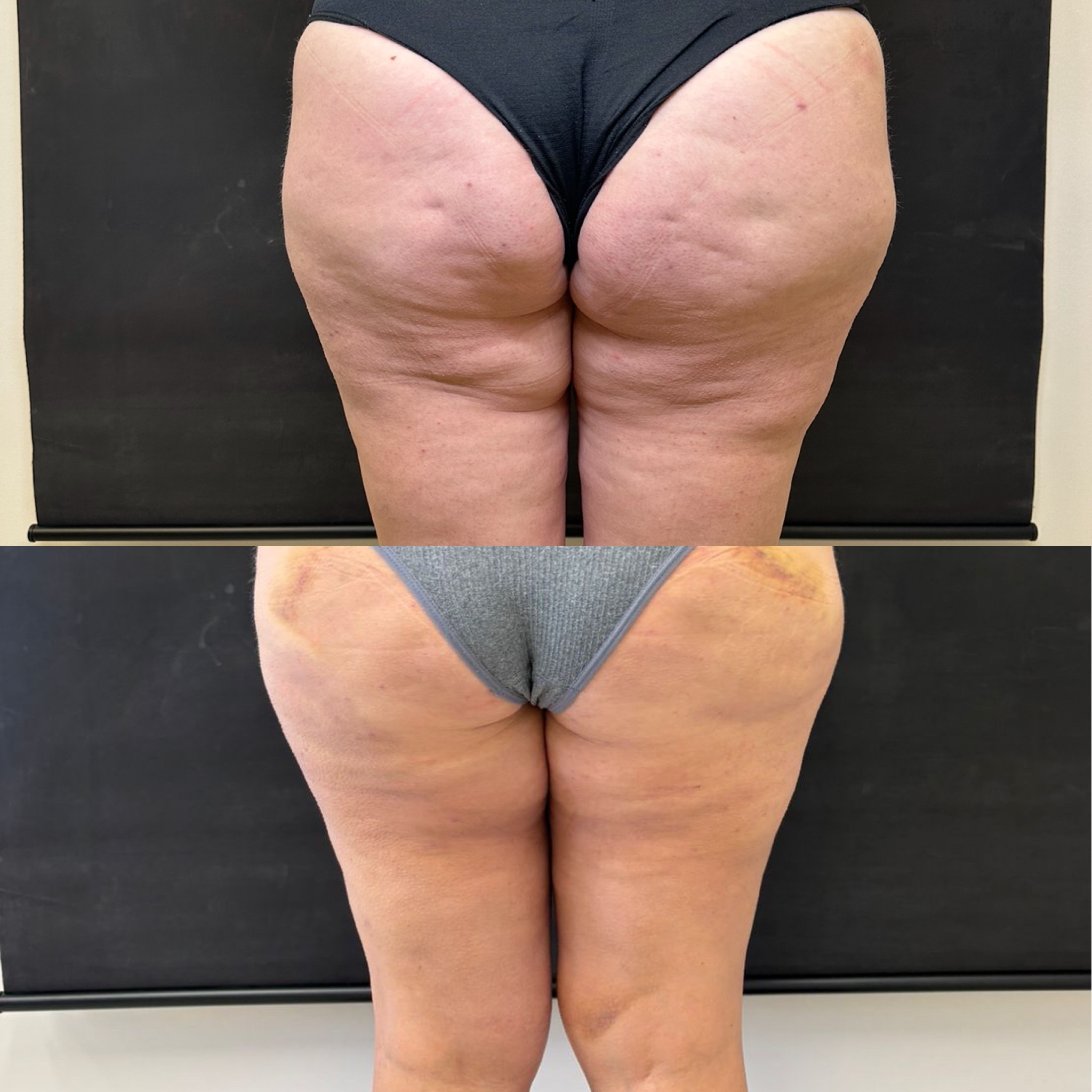 Celulite — septos fibrosos que causam os furinhos