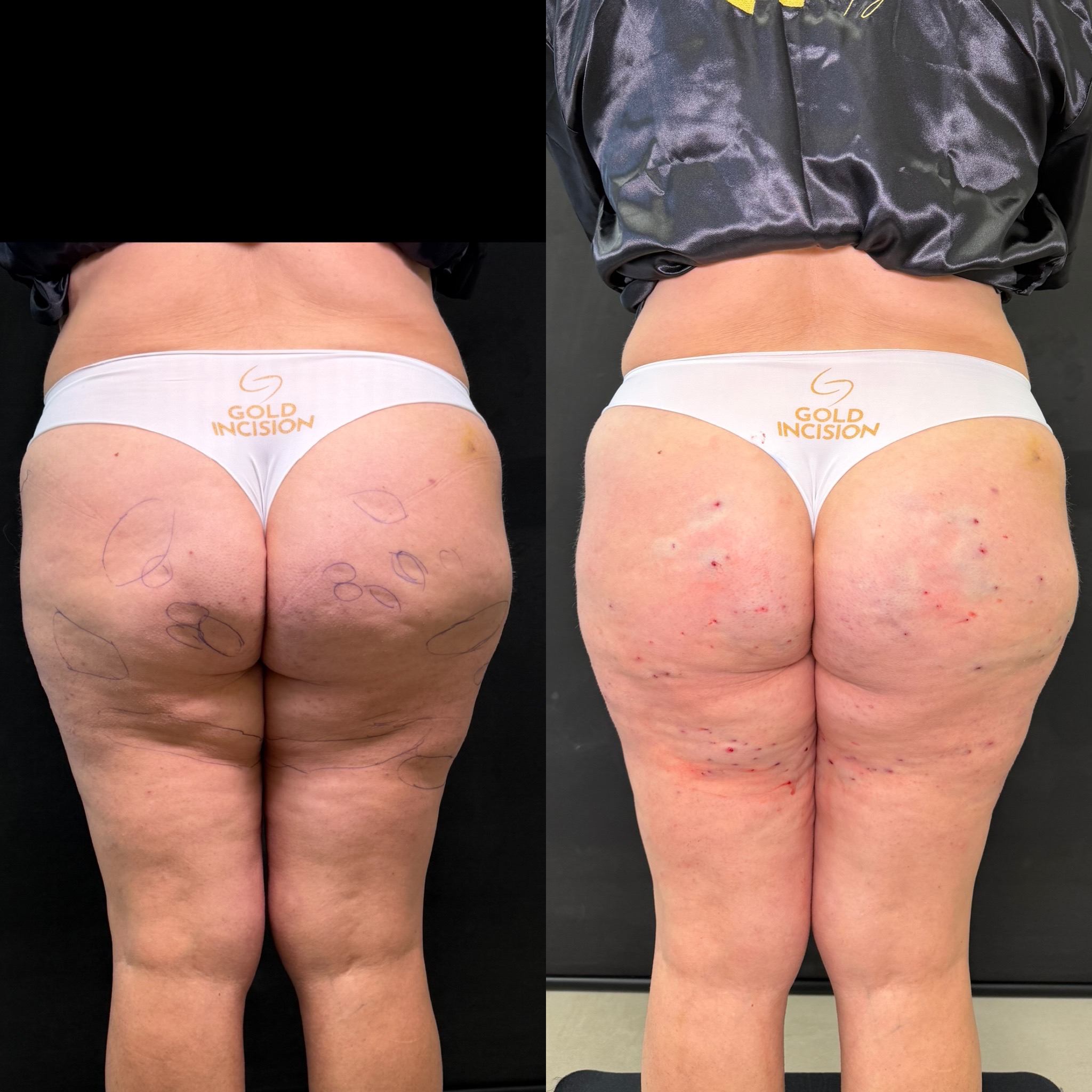 Antes e depois GoldIncision® — caso 1