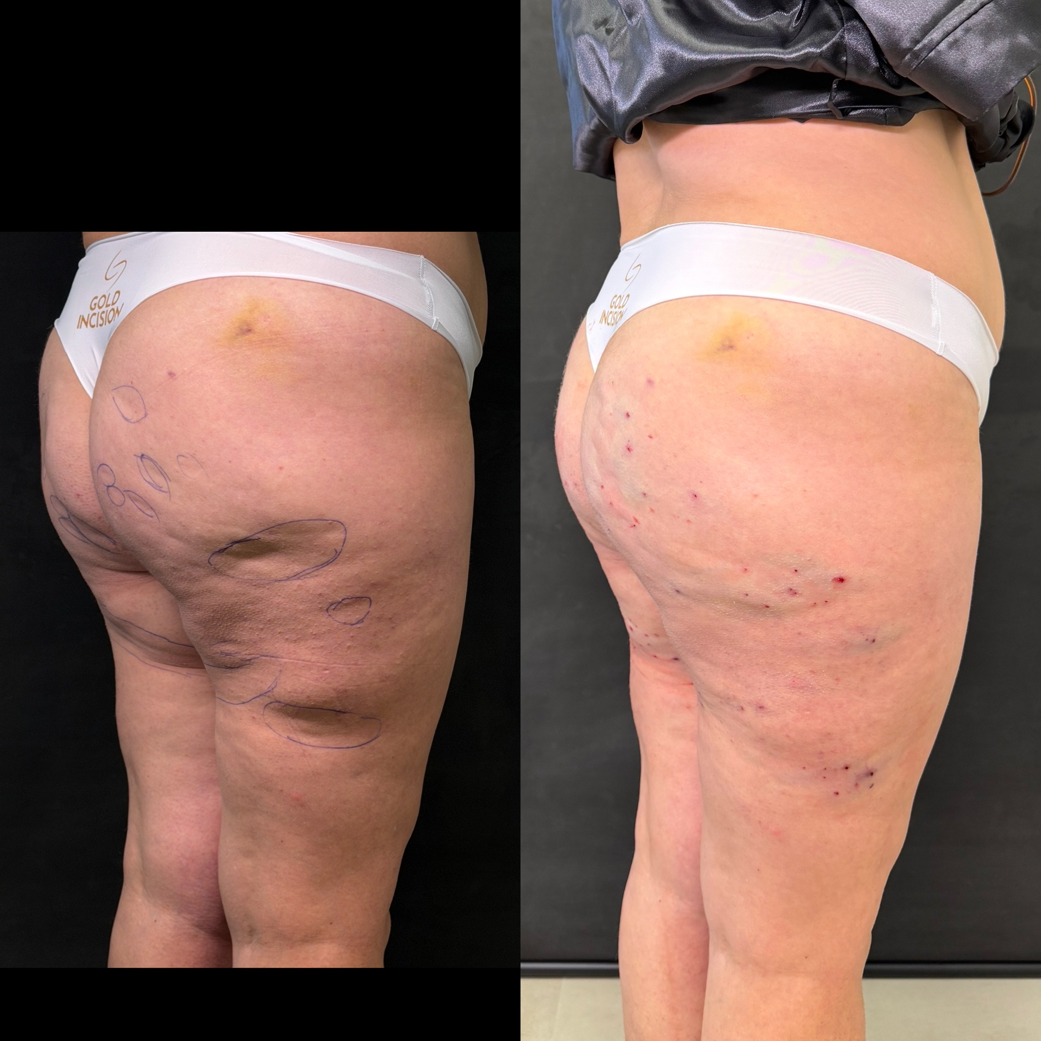 Antes e depois GoldIncision® — caso 2