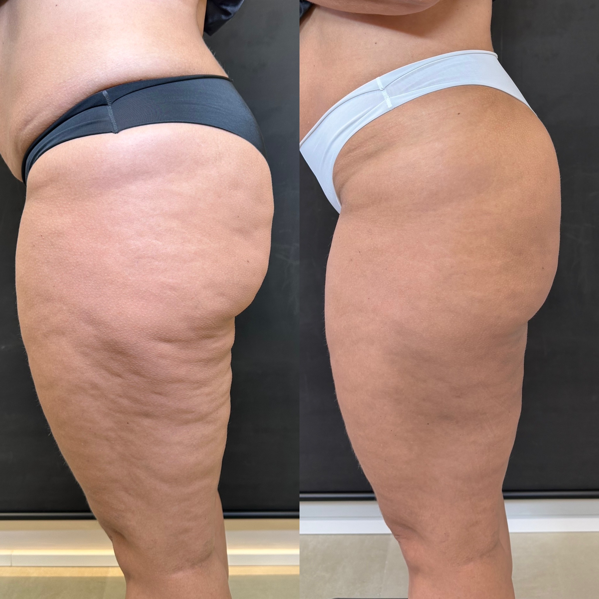 Antes e depois GoldIncision® — caso 4